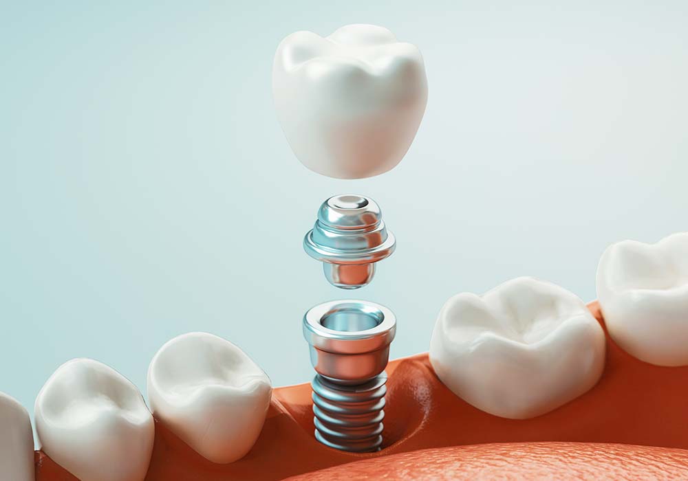 インプラント
